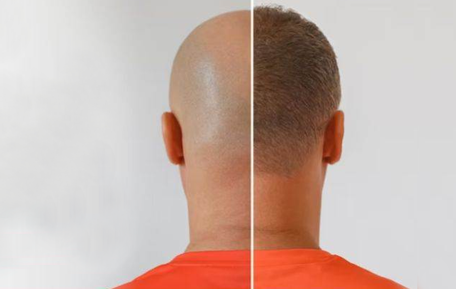 Hair Transplantation