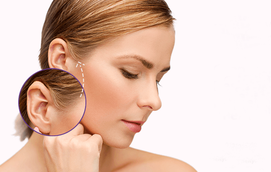 Otoplasty (For Bat Ear)