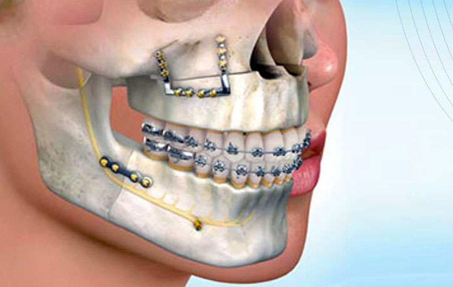 Cranio-Maxillo-Facial Surgery