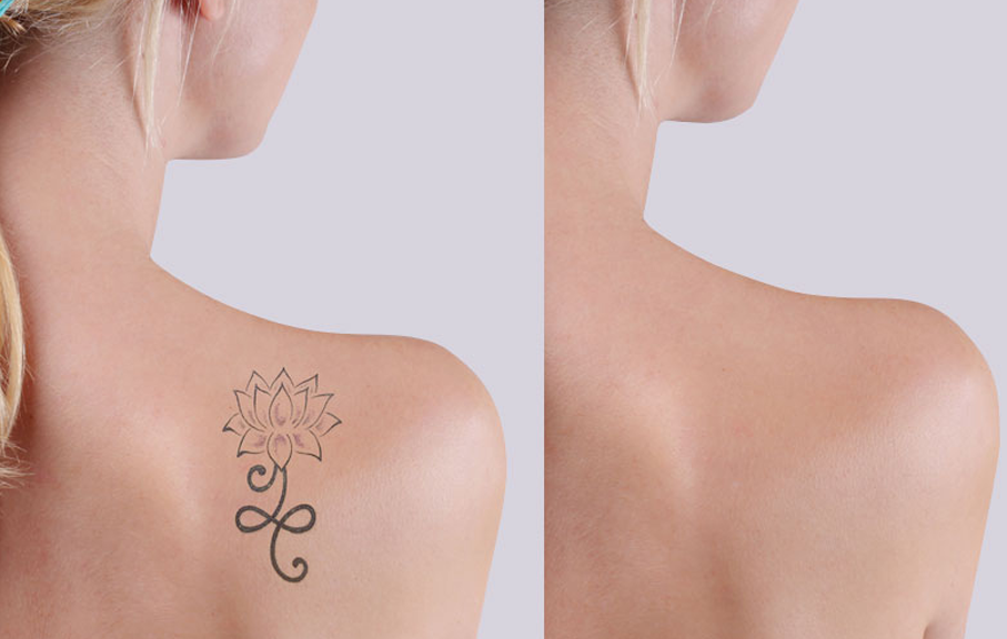 Tattoo Removal