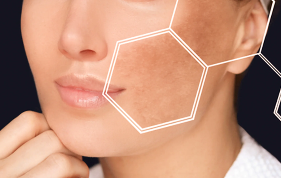 Black Patches Removal